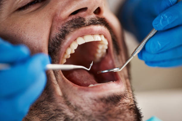Best Emergency Dentist for Lost Fillings or Crowns in Camano, WA