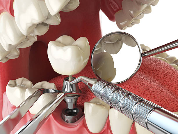 Best Broken or Cracked Tooth Emergency Dentist in Camano, WA