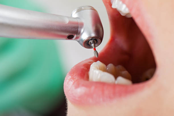 Best Emergency Dental Extractions in Camano, WA